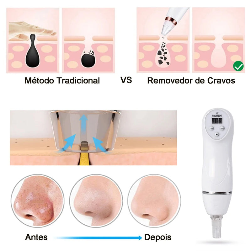 6 bicos de vácuo profissional kit peeling diamante microdermoabrasão máquina beleza portátil acne remoção cravo